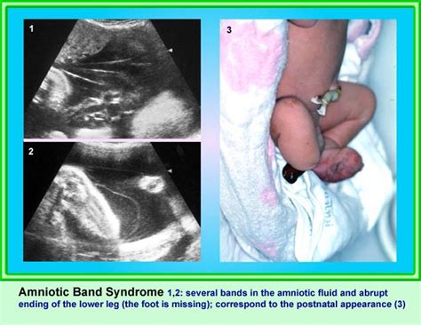 Amniotic Band Syndrome Department Of Obstetrics And Gynecology