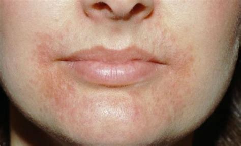 Causes Of Dry Skin Around Mouth Lips Or Nose Skincarederm