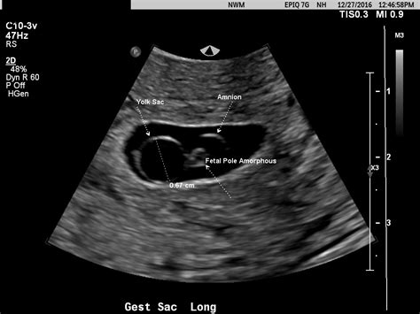 Gestational Sac Fetal Pole Ultrasound Wallpaper