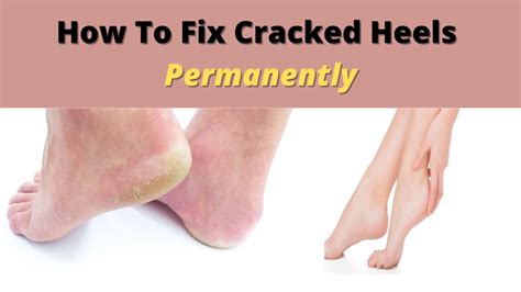 How To Fix Cracked Heels Permanently And Get Soft Feet At Home Hubpages