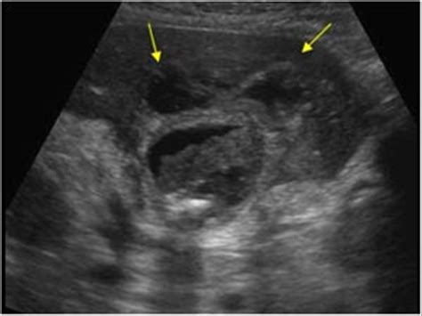 Cholelithiasis And A Cholecystitis With A Gallbladder Perforation