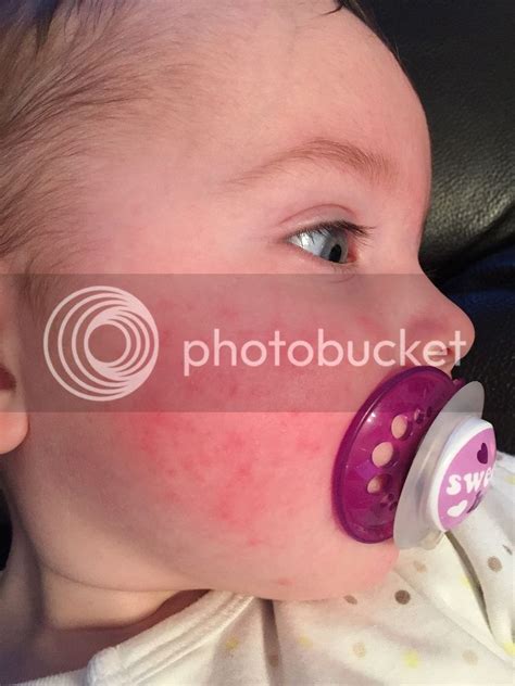 Baby Has Rash On Face What Could It Be Pic August 2014 Birth