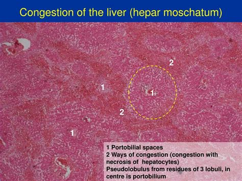 Ppt Pathology Of The Liver Powerpoint Presentation Free Download