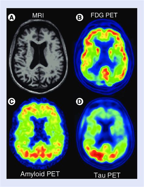 This Posterior Cortical Atrophy Patient Presented With Prosopagnosia
