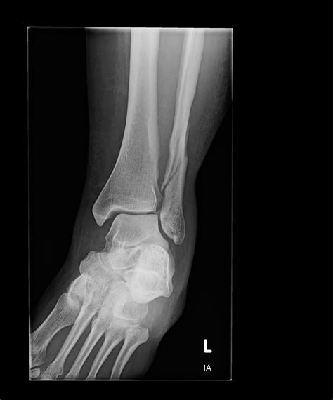 Orthodx Ankle Fracture In Young Woman Clinical Advisor