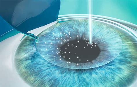 Augenlasern LASIK Institut für Augenheilkunde