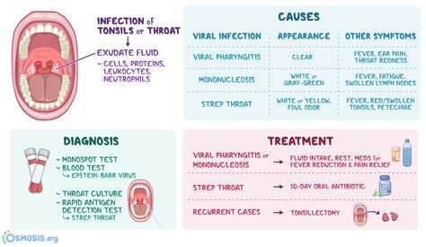 Tonsil Viral Infection