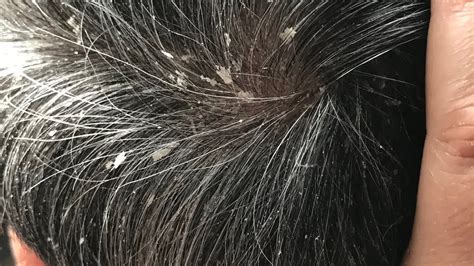 How To Remove Dandruff From Scalp How To Overcome And Remove Dandruff