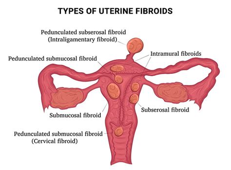 Fibroid Symptoms Vein Endovascular Medical Care
