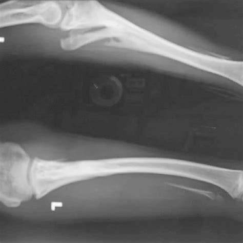 Follow Up Radiograph Of Left Forearm Anteroposterior And Lateral