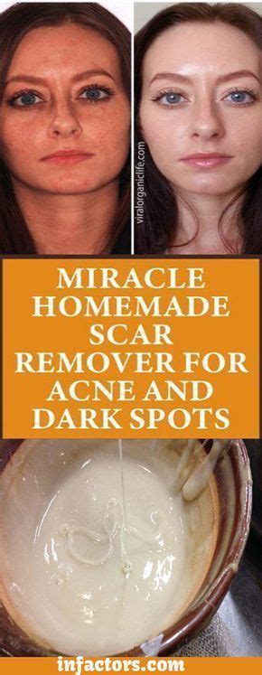 Mix 1 part apple cider vinegar and 3 parts water (use more water for sensitive skin). MIRACLE HOMEMADE SCAR REMOVER FOR ACNE AND DARK SPOTS ...