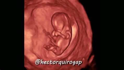 3d Ultrasound At 11 Weeks Of Pregnancy Youtube