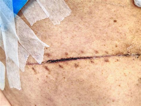 120 Hernia Scars Stock Photos Pictures And Royalty Free Images Istock
