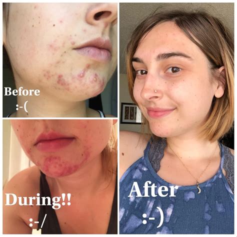 Tretinoin Before And After Before And After Acne Acne Skin Skin Care