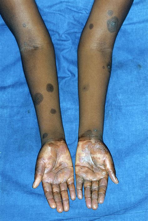 Aids Patient With Drug Allergy Photograph By Dr Ma Ansaryscience