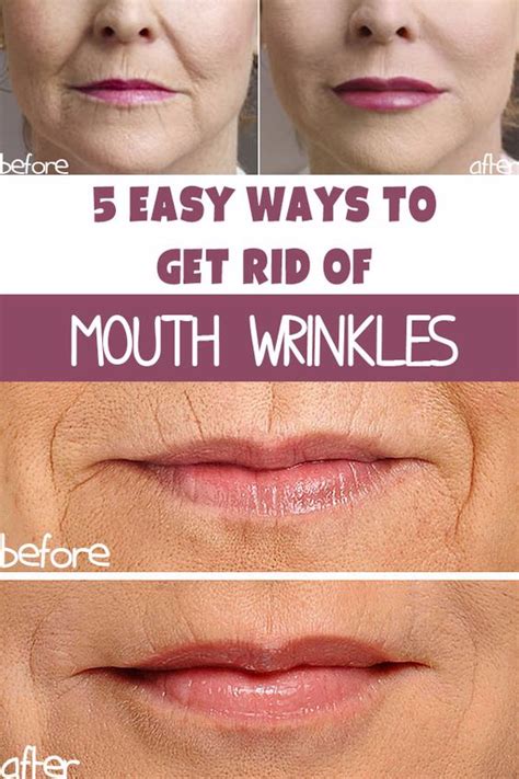 5 Ways To Get Rid Of Wrinkles Around The Mouth Healthytips
