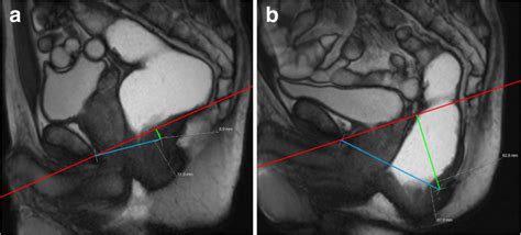 Dynamic Magnetic Resonance Imaging Of The Female Pelvic Floor—a Pictorial Review Insights Into