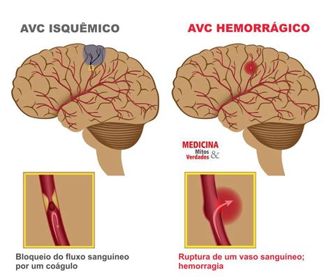 Los infartos cerebrales isquémico se producen por el bloqueo en las venas o arterias del. El Show de Alex "El Genio" Lucas | Síntomas de un derrame ...