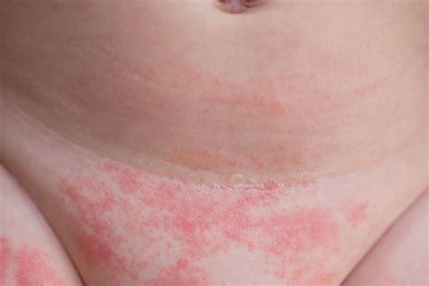 Dermatita De Scutec Cauze Simptome Si Tratament The Best Porn Website