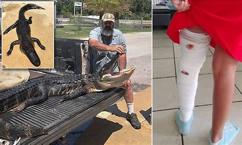 Horrific Injuries Of Florida Girl Attacked By Gator Daily Mail Online