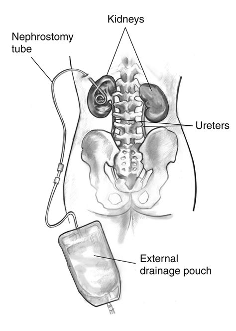 Nephrostomy Tube Bag