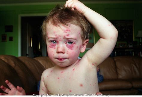 Chickenpox Characterised By The Appearance On Skin And Mucous Membranes