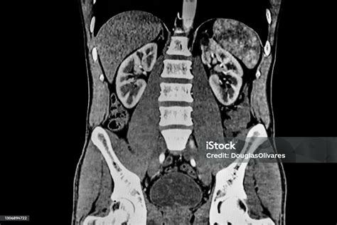 Ct Scan Of Abdomen Showing Liver Kidney And The Spine Stock Photo