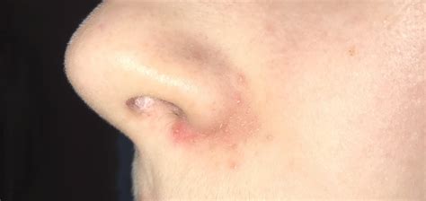 Help Please Rash Around Nose Pimple Like Bumps That Dont Pop And Dry