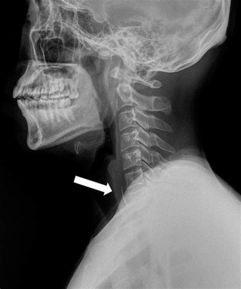 In A Plain Neck Lateral Film An Approximately 2 Cm Sized Radiopaque