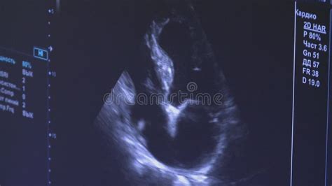 Medical Ultrasound Scan Heart Echocardiogram Stock Footage Video Of