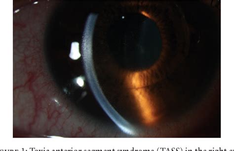 Figure 1 From Toxic Anterior Segment Syndrome After Foldable Artiflex Iris Fixated Phakic