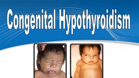Congenital Hypothyroidism Pictures
