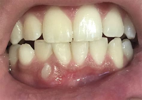 Supernumerary Tooth Growing In Front Dentistry