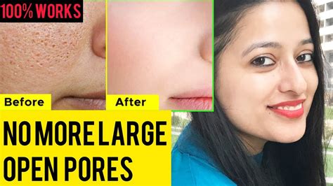 How To Shrink Open Pores Permanently Get Rid Of Large Open Pores
