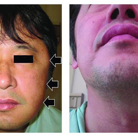 Swelling On The Left Side Of The Patients Face The Swelling On The