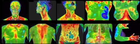 What Is Medical Thermography Institute For The Advancement Of Medical