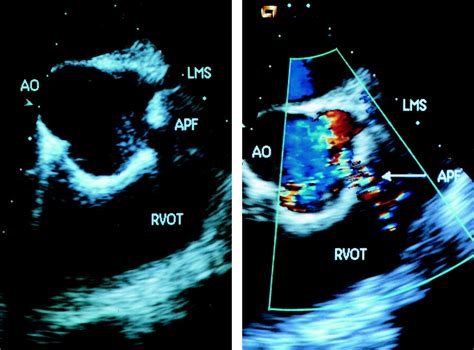 Traumatic Aortopulmonary Fistula Echocardiographic Appearance Heart