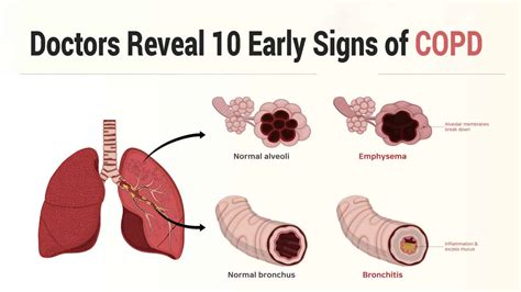Doctors Reveal 10 Early Signs Of Copd 7 Minute Read