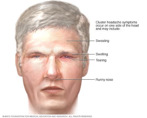 Cluster Headache Symptoms And Causes Mayo Clinic