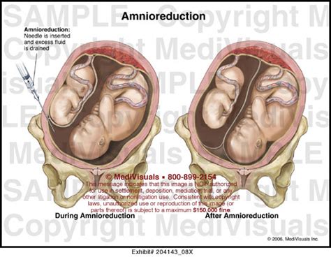 Amnioreduction Medical Illustration Medivisuals