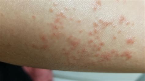 Helpp I Have This Red Bumpy Acne Rash On My Forearm That Sting When