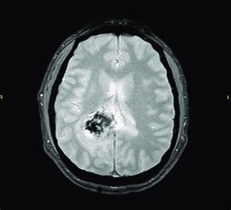 Mri Brain T2 Weighted Axial Gradient Echo Sequences Gre Image