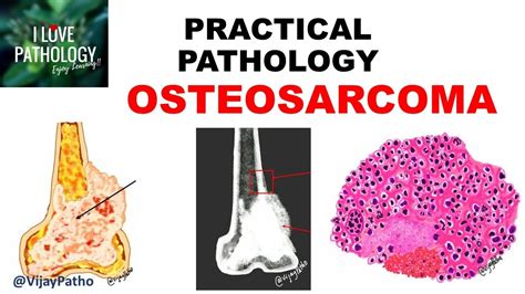 Osteosarcoma Clinical Radiological Features And Morphology Youtube