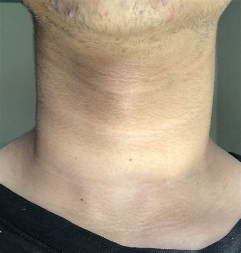 Skin Concern Whats Going On With My Neck Its Dark In Some Areas