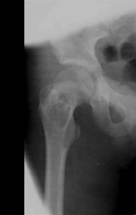 Simple Bone Cyst Right Femur X Rays Case Studies Ctisus Ct Scanning