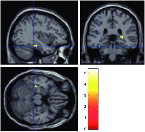 Regions With Higher Functional Connectivity With The Left Precuneus In