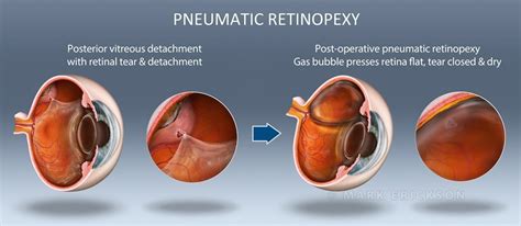 Patient Education Illustration Of Pneumatic Retinopexy Treatment