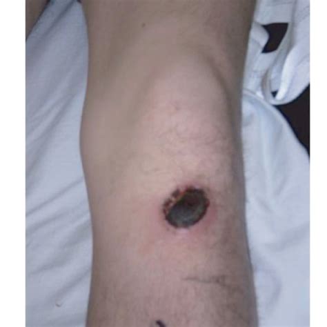 (PDF) Pretibial Full Thickness Skin Burn following Indirect Contact
