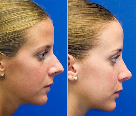 The Over Projected Long Nose Rhinoplasty Seattle Facial Plastic
