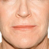 Sagging Jowls | Redefine Your Neck & Jaw Line | Phone 01 ...